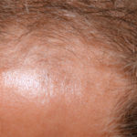 Permanent Cosmetic Design in Boise, ID | Hair Restoration